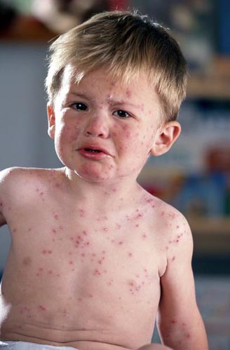 смысл детских аллергий